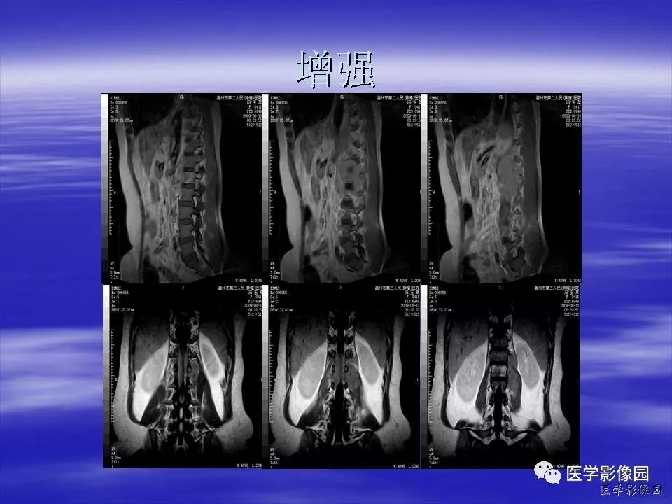 【病例】脊柱淋巴瘤1例MR影像表现 【病例】脊柱淋巴瘤1例MR影像表现