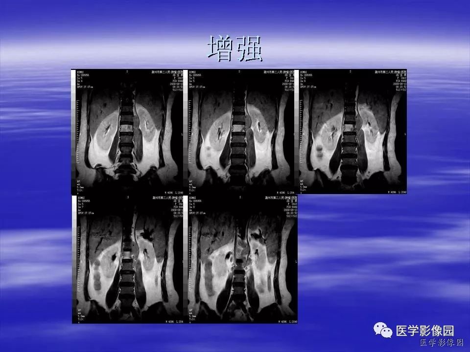 【病例】脊柱淋巴瘤1例MR影像表现 【病例】脊柱淋巴瘤1例MR影像表现
