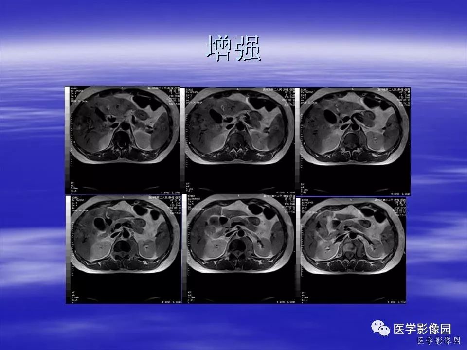 【病例】脊柱淋巴瘤1例MR影像表现 【病例】脊柱淋巴瘤1例MR影像表现