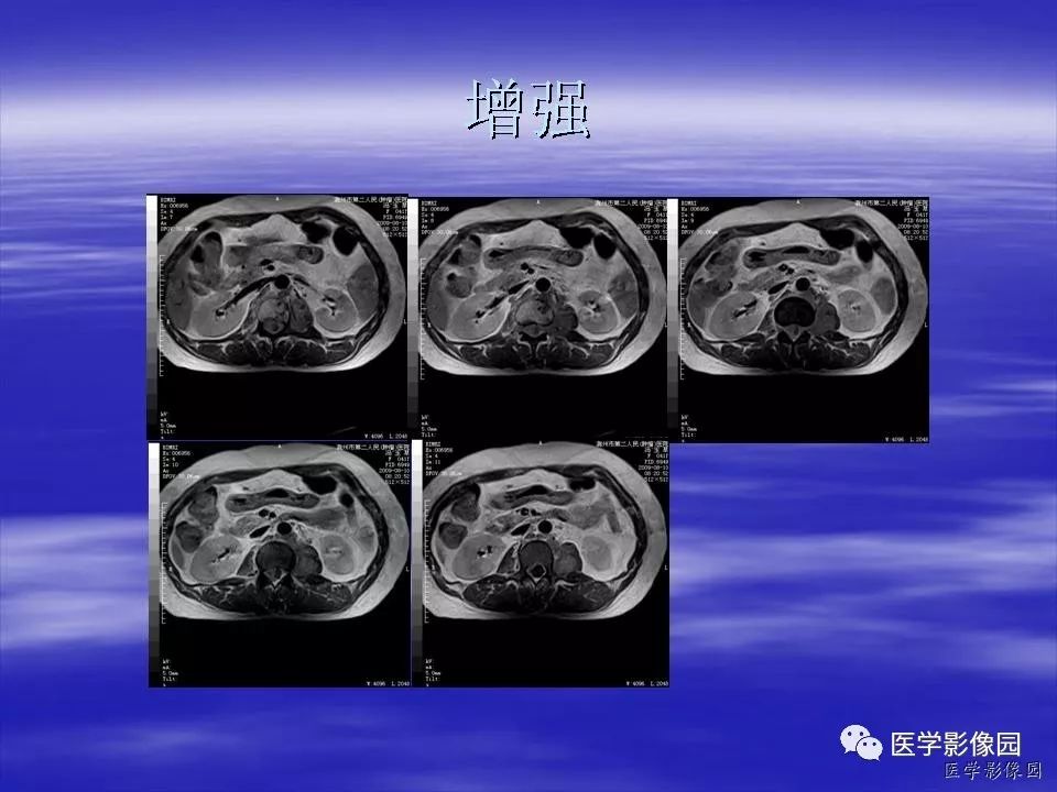 【病例】脊柱淋巴瘤1例MR影像表现 【病例】脊柱淋巴瘤1例MR影像表现