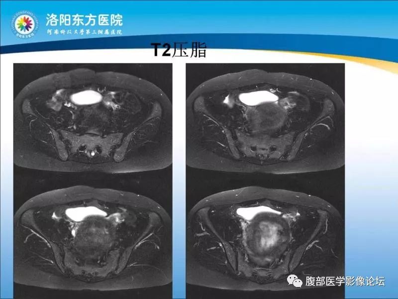 【病例】子宫内膜间质肉瘤1例MR