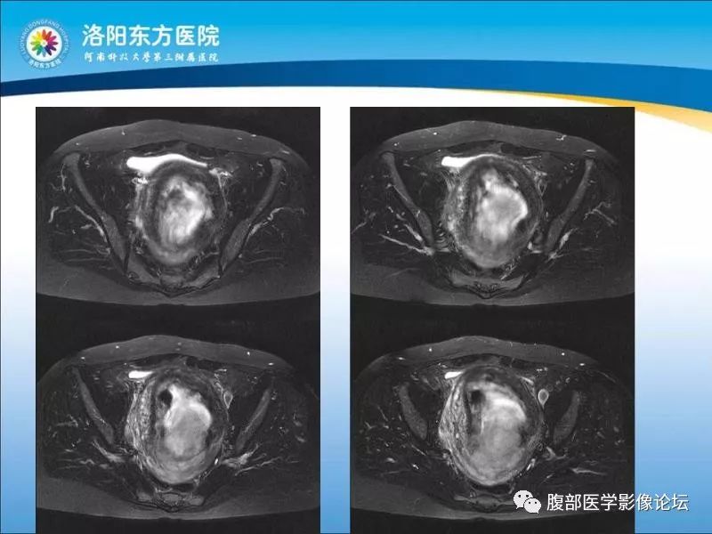 【病例】子宫内膜间质肉瘤1例MR