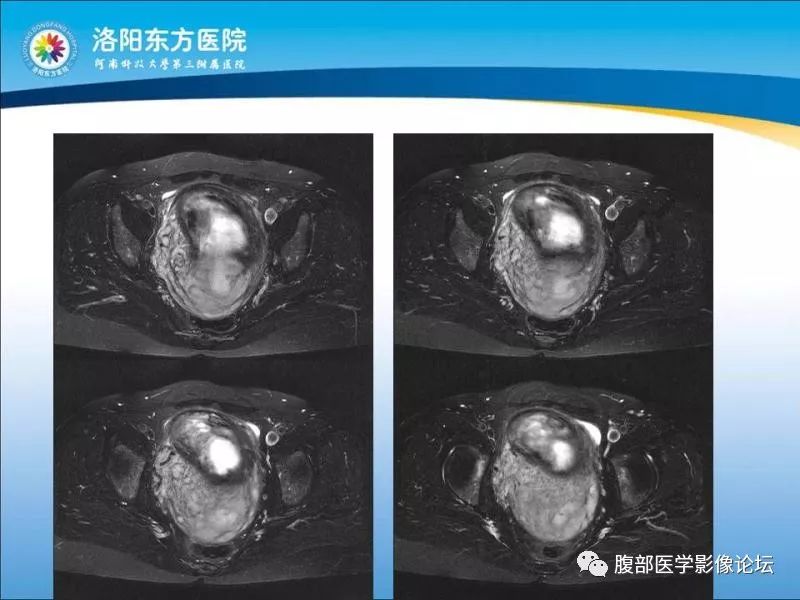 【病例】子宫内膜间质肉瘤1例MR