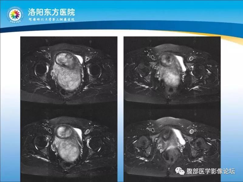 【病例】子宫内膜间质肉瘤1例MR