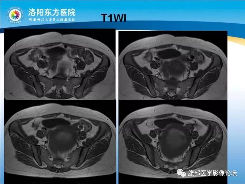 【病例】子宫内膜间质肉瘤1例MR