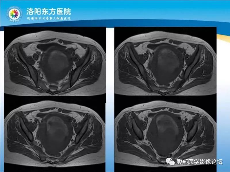【病例】子宫内膜间质肉瘤1例MR
