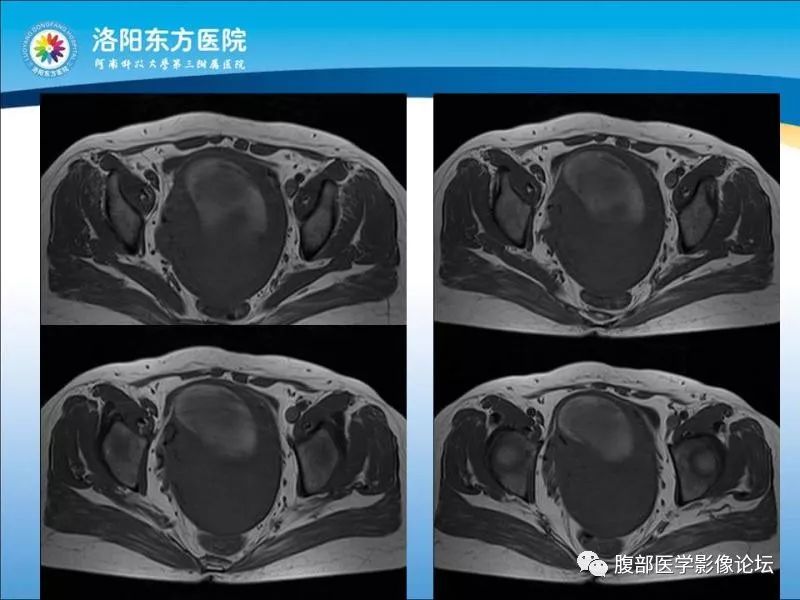【病例】子宫内膜间质肉瘤1例MR