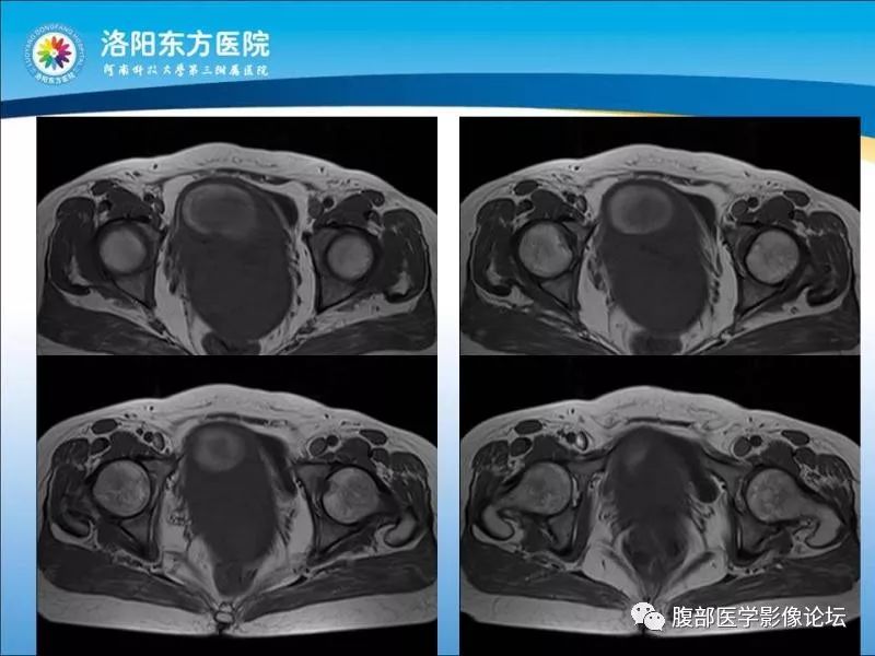 【病例】子宫内膜间质肉瘤1例MR