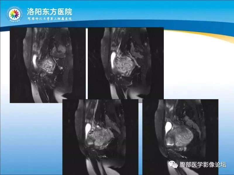 【病例】子宫内膜间质肉瘤1例MR