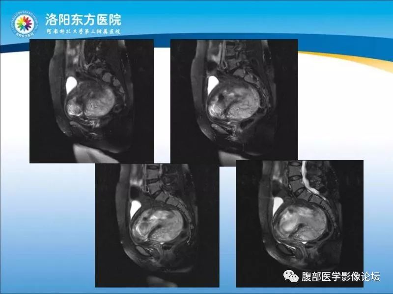 【病例】子宫内膜间质肉瘤1例MR