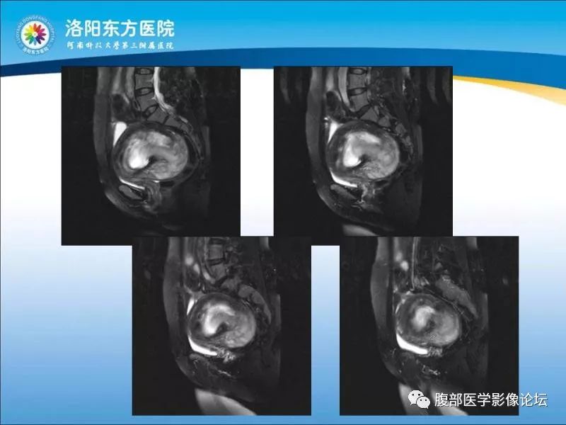 【病例】子宫内膜间质肉瘤1例MR