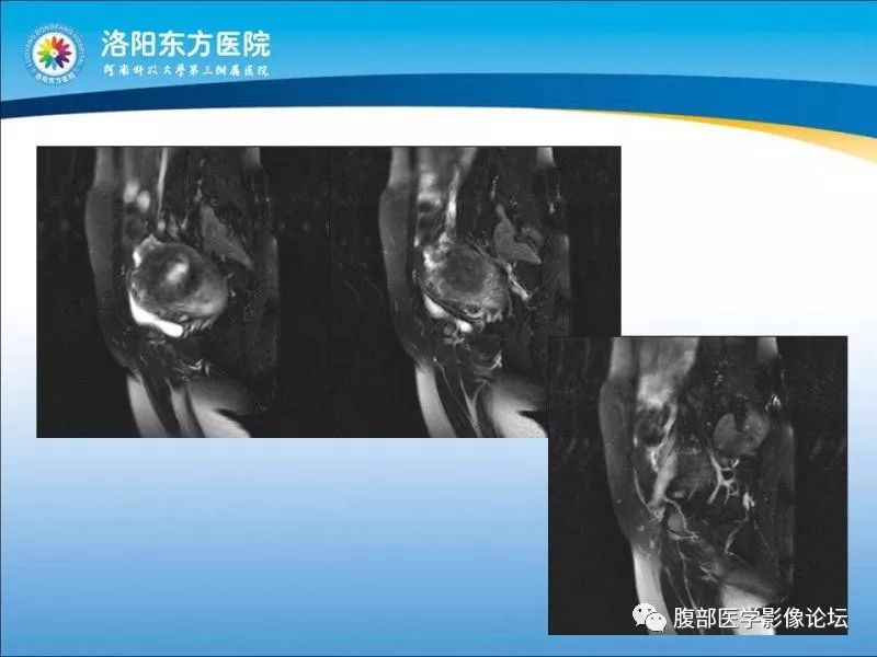 【病例】子宫内膜间质肉瘤1例MR