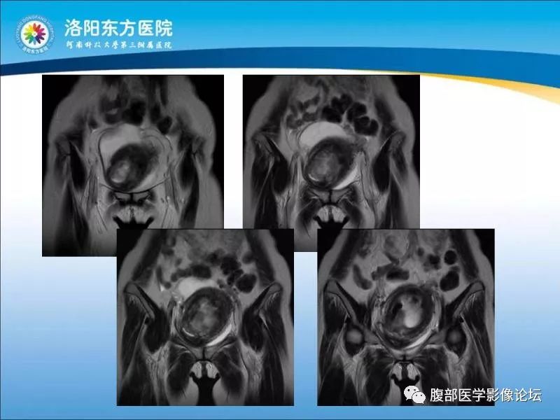 【病例】子宫内膜间质肉瘤1例MR