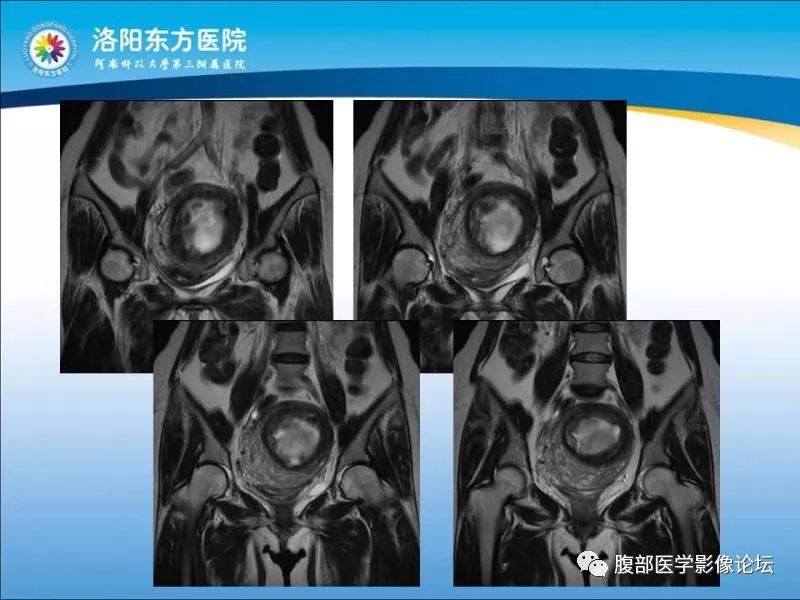 【病例】子宫内膜间质肉瘤1例MR