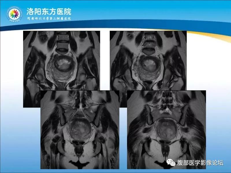 【病例】子宫内膜间质肉瘤1例MR