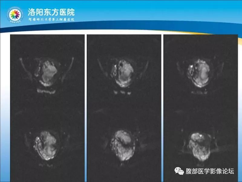 【病例】子宫内膜间质肉瘤1例MR