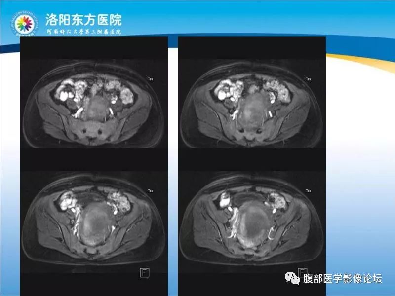 【病例】子宫内膜间质肉瘤1例MR