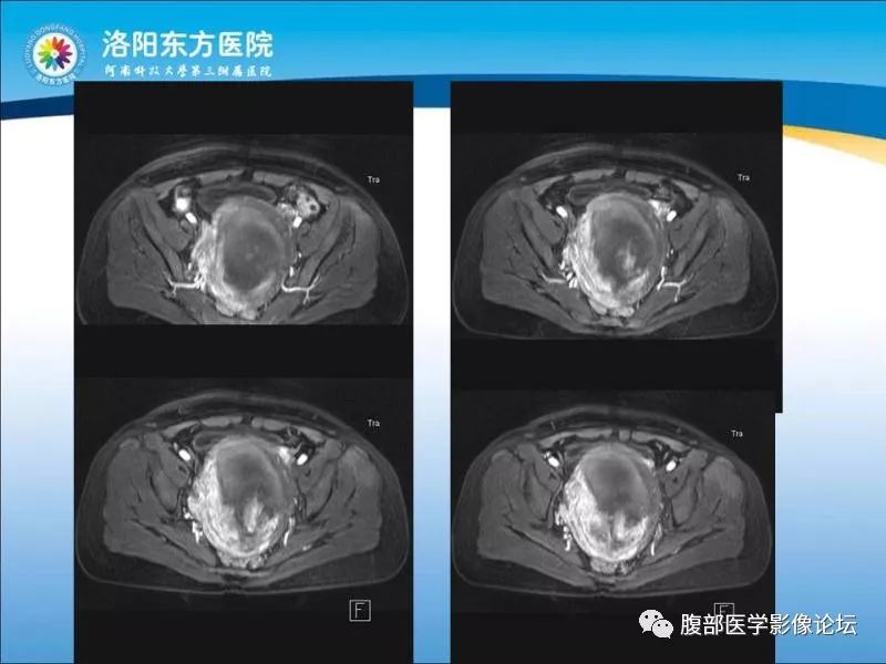 【病例】子宫内膜间质肉瘤1例MR