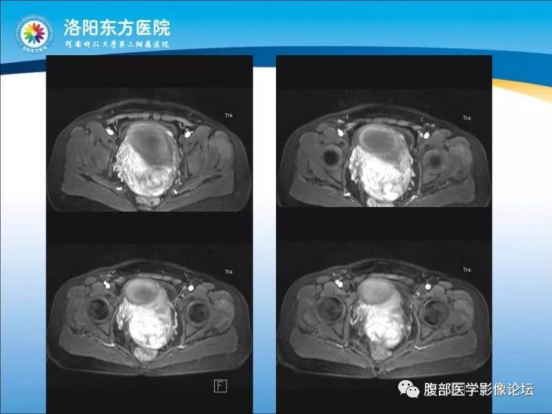 【病例】子宫内膜间质肉瘤1例MR
