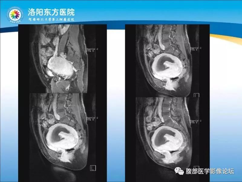 【病例】子宫内膜间质肉瘤1例MR