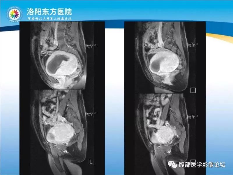 【病例】子宫内膜间质肉瘤1例MR