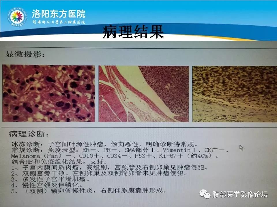 【病例】子宫内膜间质肉瘤1例MR