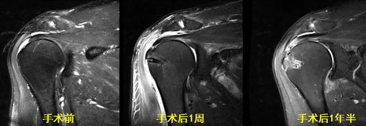 肩袖损伤的MRI诊断技巧