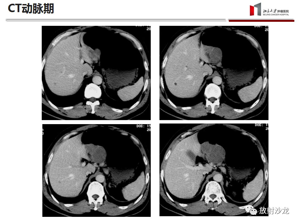 【病例】胃神经鞘瘤1例CT影像表现