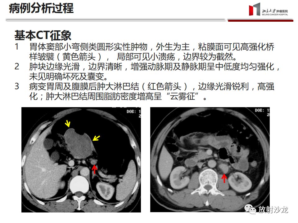【病例】胃神经鞘瘤1例CT影像表现
