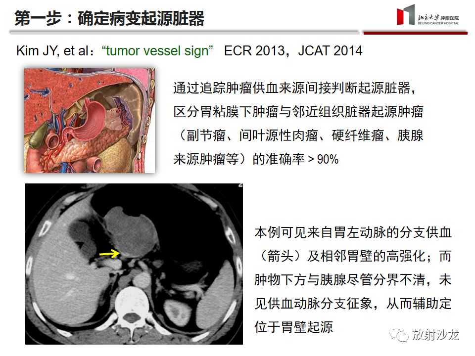 【病例】胃神经鞘瘤1例CT影像表现