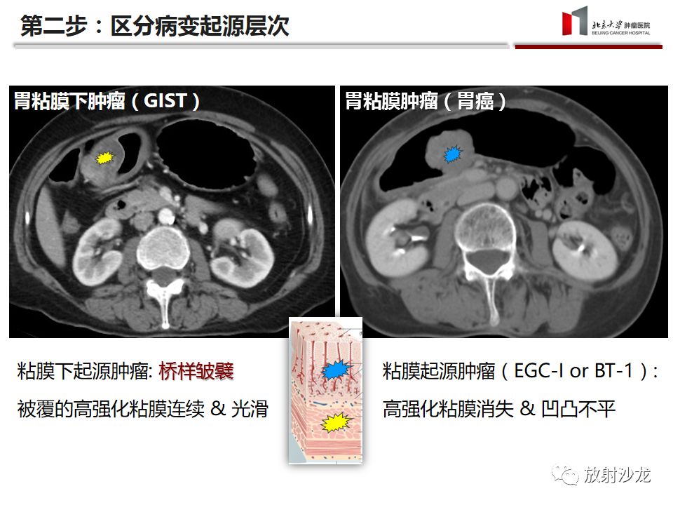 【病例】胃神经鞘瘤1例CT影像表现