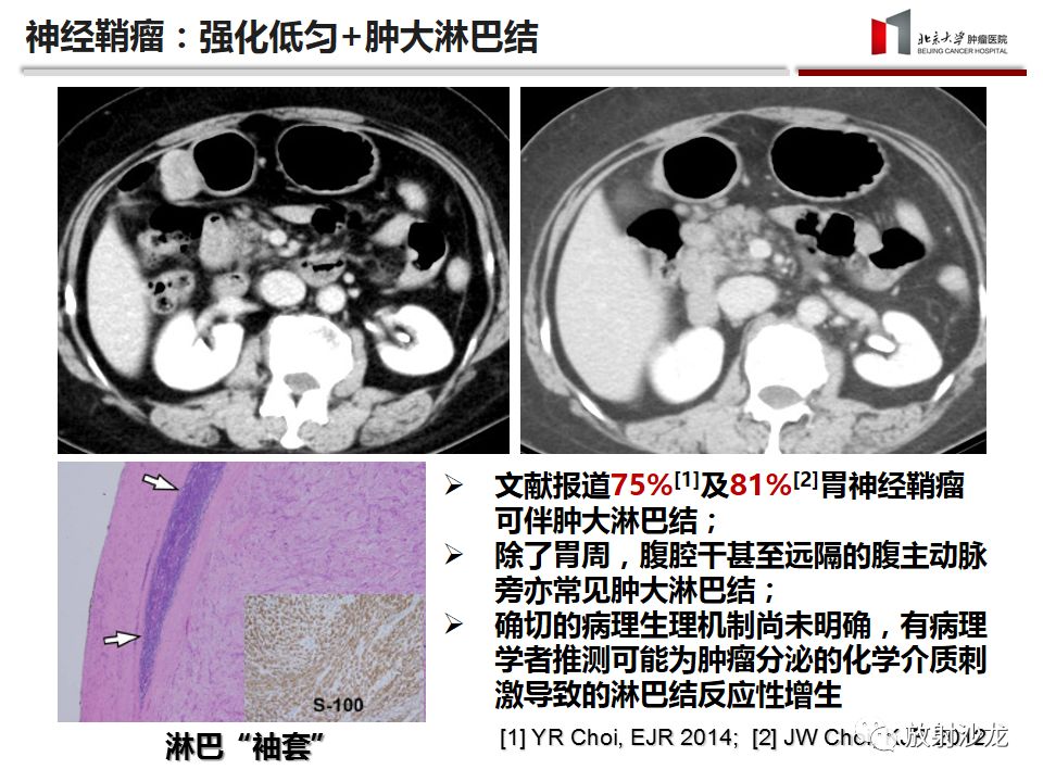 【病例】胃神经鞘瘤1例CT影像表现