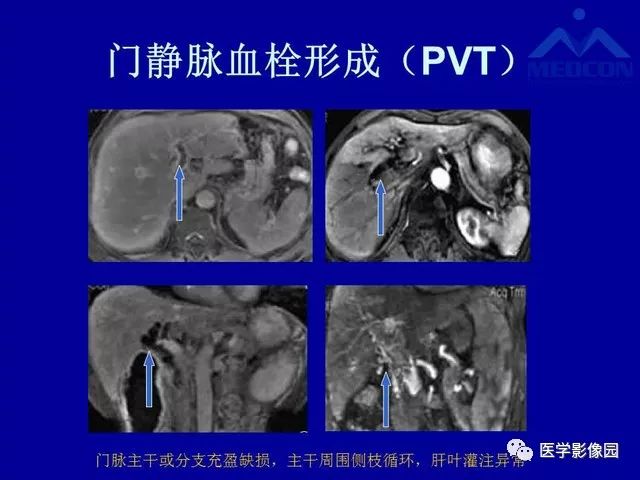 【PPT】门静脉高压分型及影像学特征