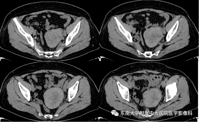 【病例】卵巢甲状腺肿1例CT影像表现