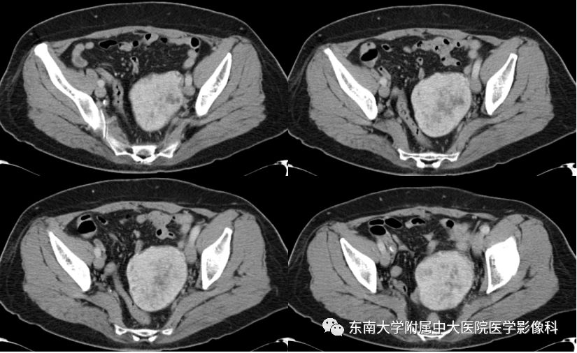【病例】卵巢甲状腺肿1例CT影像表现