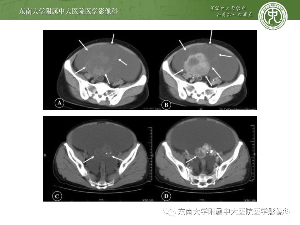 【病例】卵巢甲状腺肿1例CT影像表现