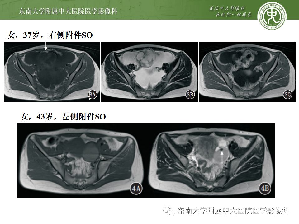【病例】卵巢甲状腺肿1例CT影像表现