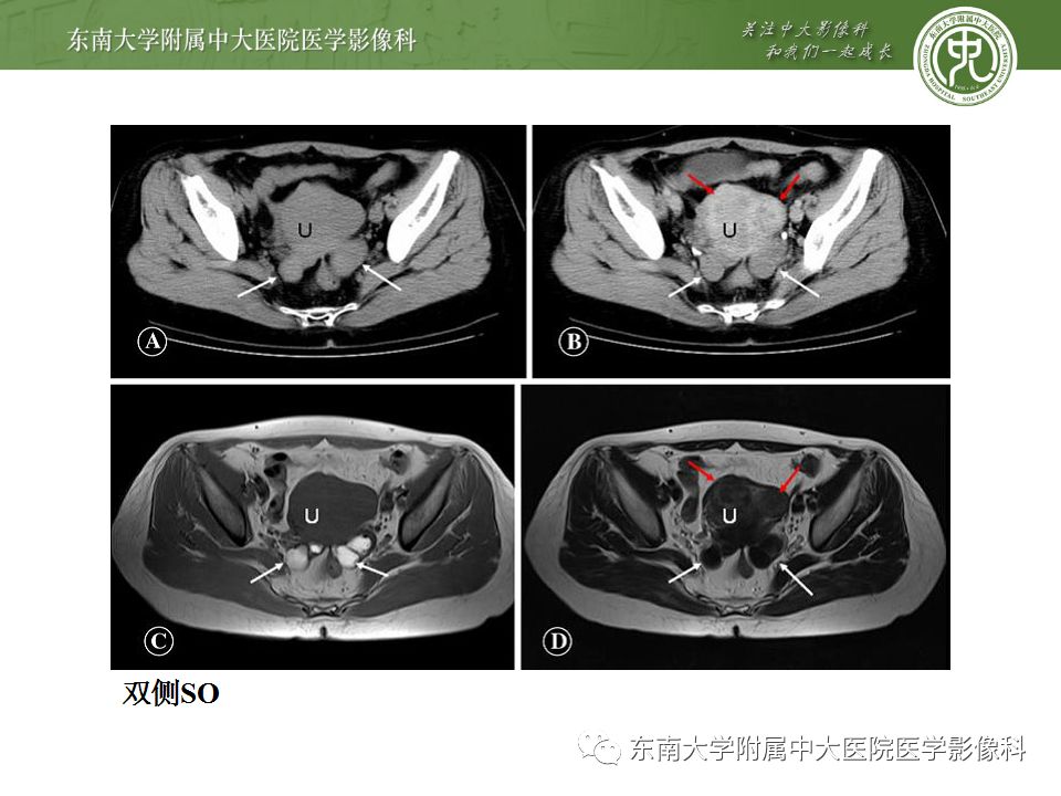 【病例】卵巢甲状腺肿1例CT影像表现