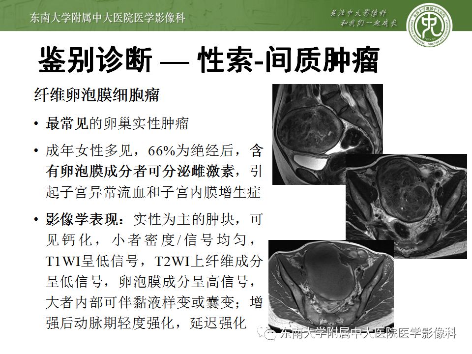 【病例】卵巢甲状腺肿1例CT影像表现