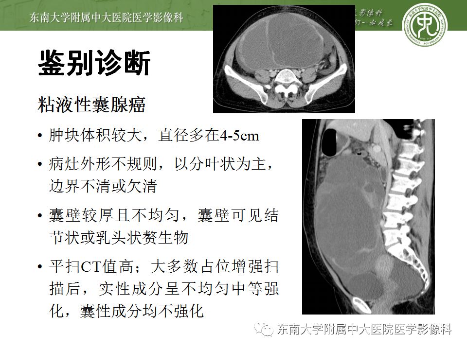 【病例】卵巢甲状腺肿1例CT影像表现
