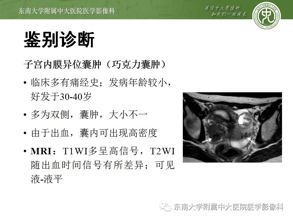 【病例】卵巢甲状腺肿1例CT影像表现