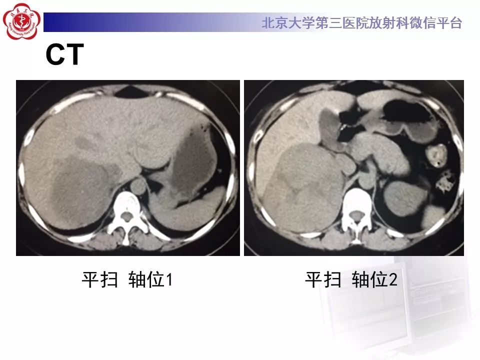【病例】肾上腺皮质腺癌1例CT及MR影像表现