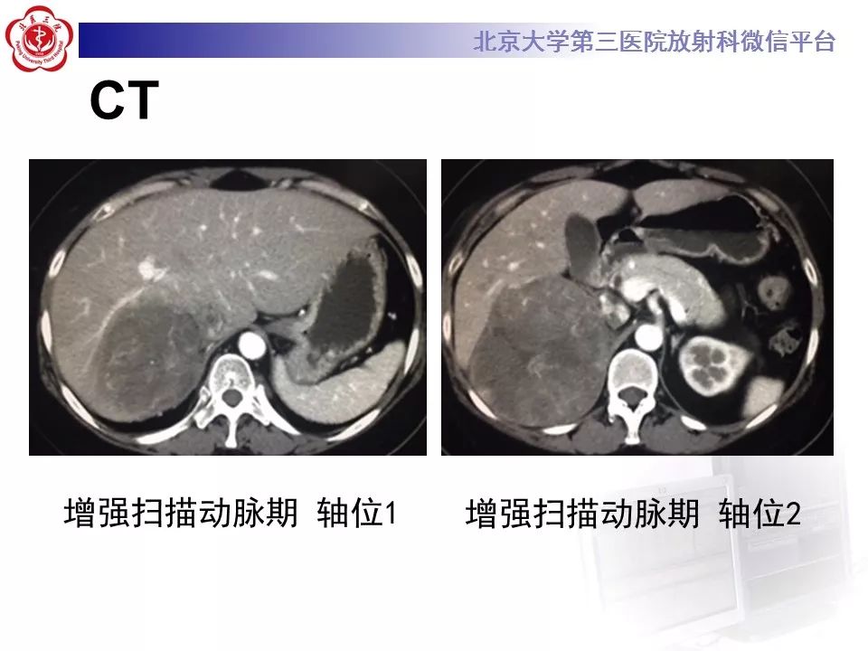 【病例】肾上腺皮质腺癌1例CT及MR影像表现