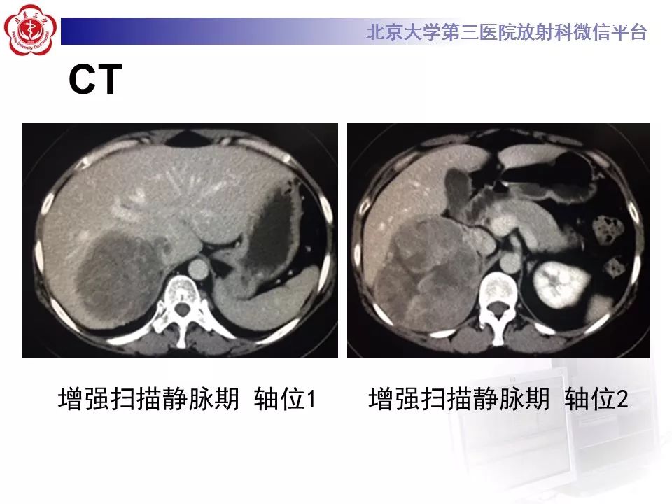 【病例】肾上腺皮质腺癌1例CT及MR影像表现