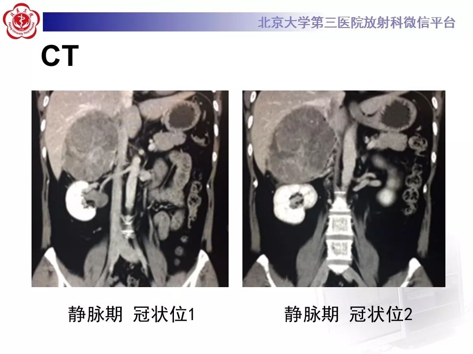 【病例】肾上腺皮质腺癌1例CT及MR影像表现