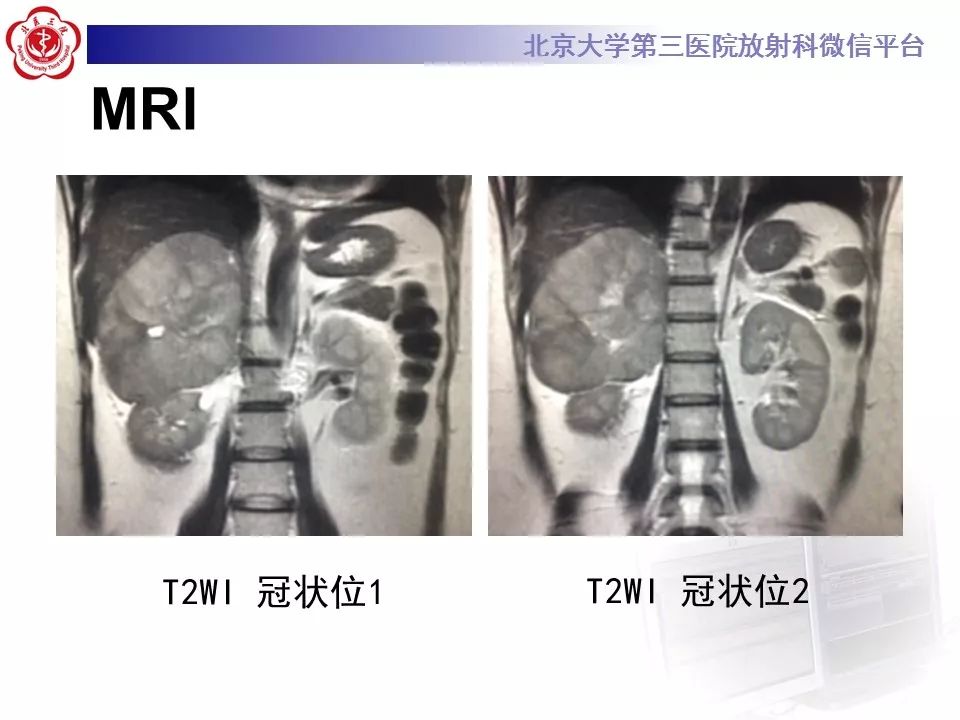 【病例】肾上腺皮质腺癌1例CT及MR影像表现