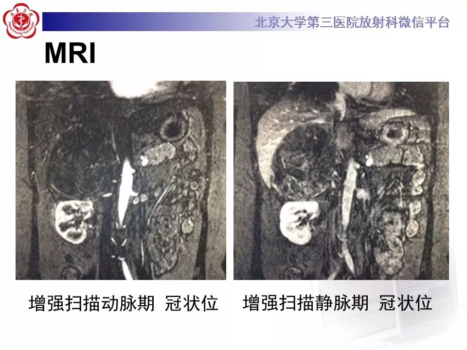 【病例】肾上腺皮质腺癌1例CT及MR影像表现
