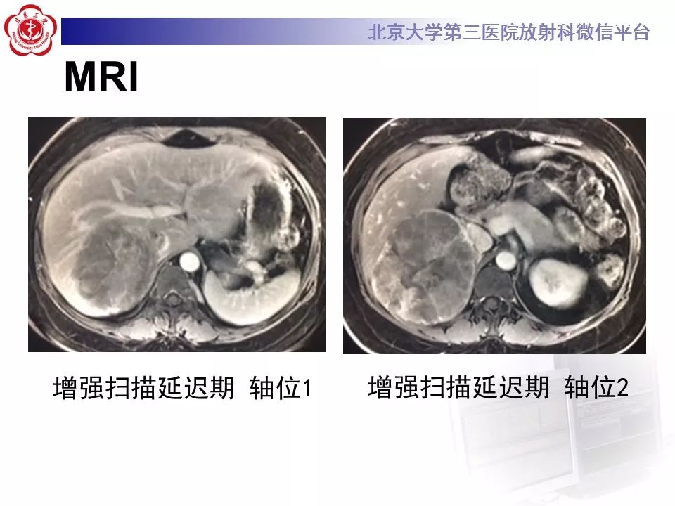 【病例】肾上腺皮质腺癌1例CT及MR影像表现