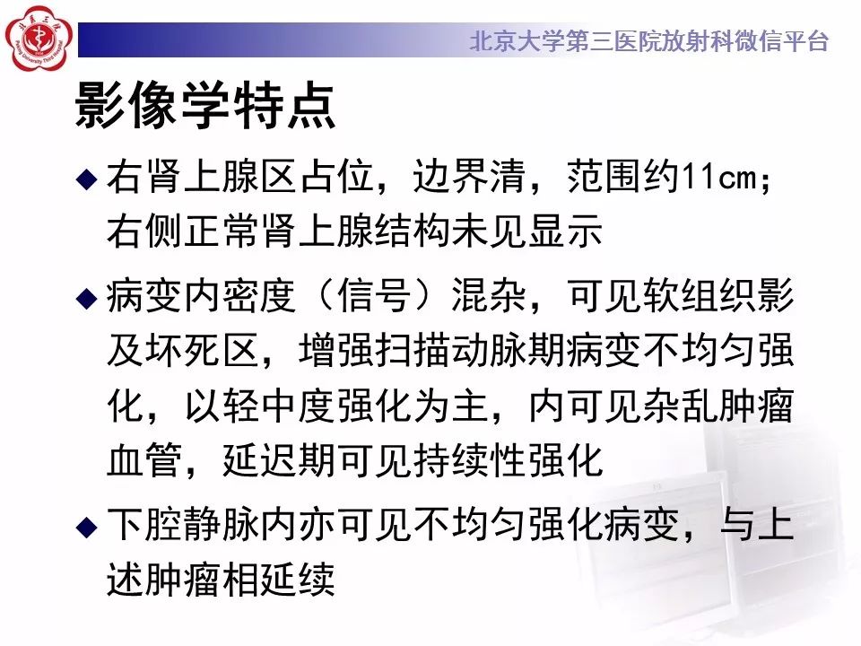 【病例】肾上腺皮质腺癌1例CT及MR影像表现