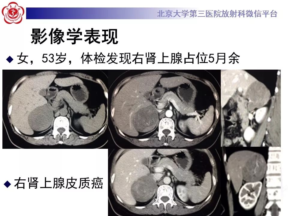 【病例】肾上腺皮质腺癌1例CT及MR影像表现